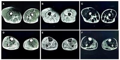 The Novel Compound Heterozygous Mutations in the AGL Gene in a Chinese Family With Adult Late-Onset Glycogen Storage Disease Type IIIa